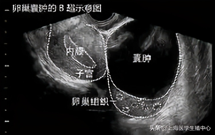 孕三个月卵巢囊肿,卵巢囊肿会影响肺吗