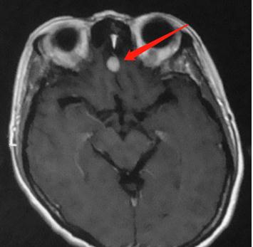 脑膜瘤有些什么症状,脑膜瘤症状有哪些啊
