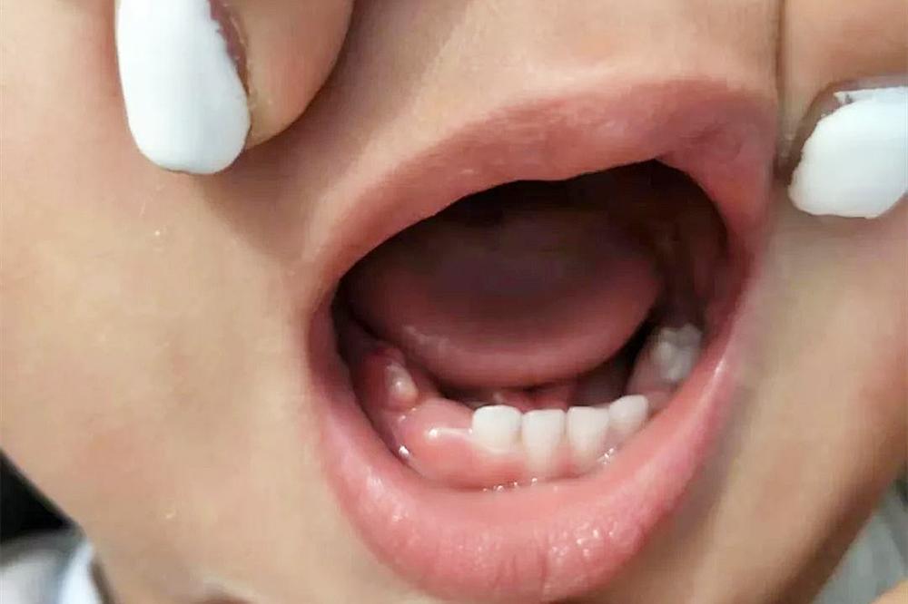 宝宝出牙症状顺序护理知识全攻略,长牙不按顺序出牙正常吗