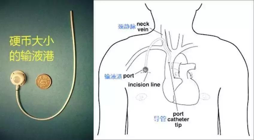 医院首例下腔静脉滤器植入,静脉输液港植入后效果图