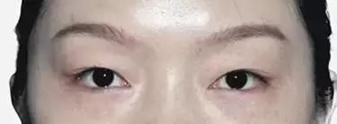 把水光针当饭吃？这位网红简直丧心病狂！整容后年入千万