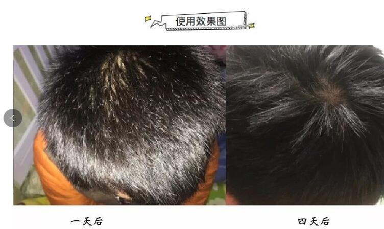 RooLife：去屑！这个可比海X丝好用多了