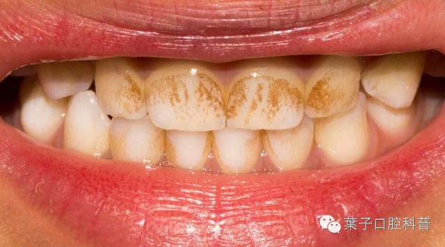 小孩可以洗牙视频,儿童可以洗牙吗洗牙的过程是什么