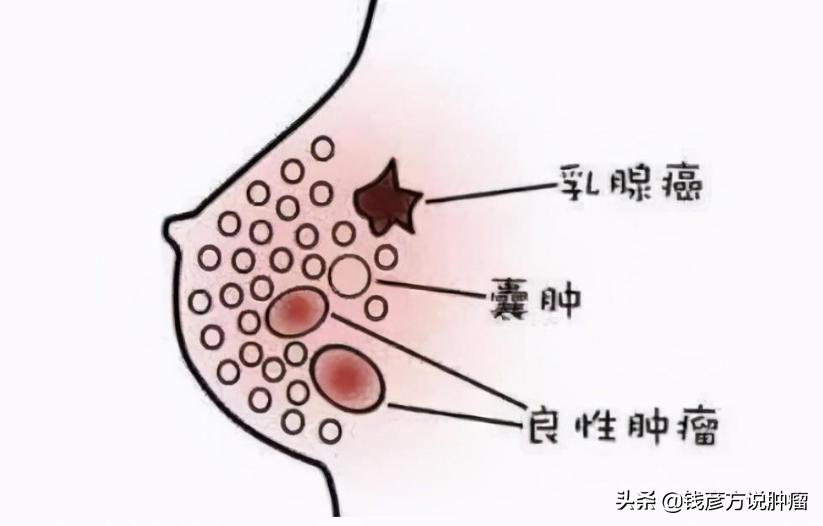 上海乳腺癌中医治疗全国最好医院,乳腺癌不化疗选择中医治疗科学吗