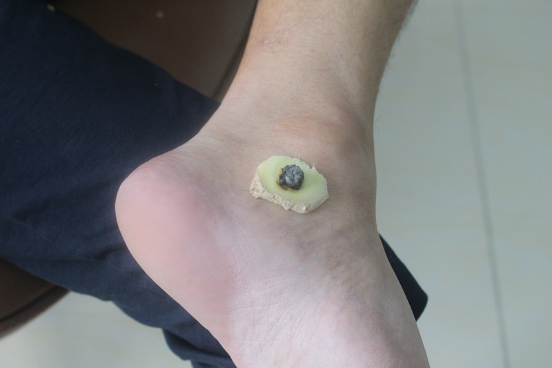 艾灸百会穴出现头晕是怎么回事,闻了艾灸味头晕恶心是怎么回事