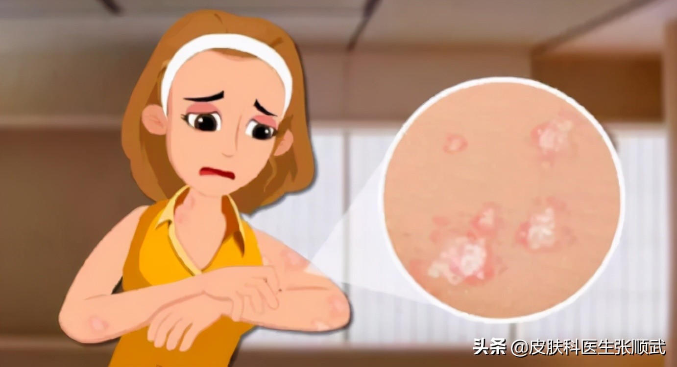 得了银屑病用什么药膏才能好,得了银屑病要预防什么