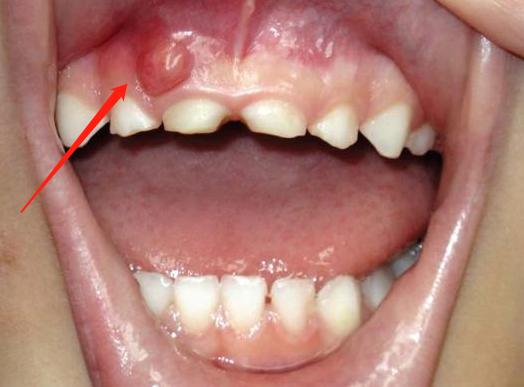 小孩子牙龈长脓包要做根管治疗吗,根管治疗两年后牙龈长脓包怎么办