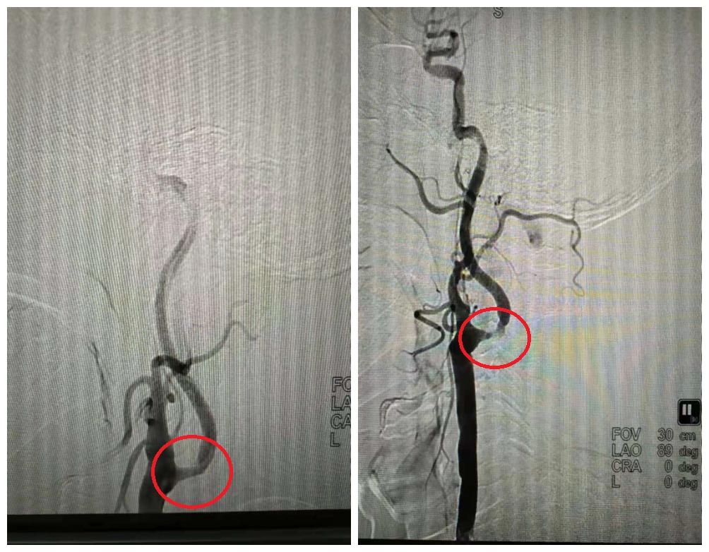 75岁老人多发性脑梗死，DSA介入治疗打通大脑“生命线”