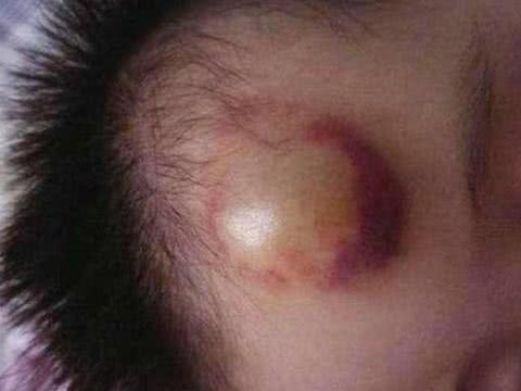 宝宝从80厘米床掉下来怎么办,婴儿坠床摔到头后多久脱离危险