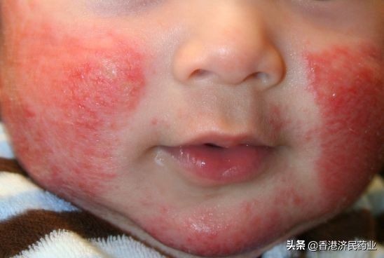 儿童最新有效鼻炎药,儿童ad滴剂