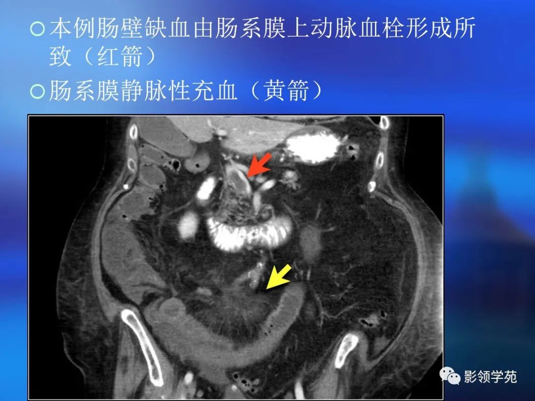 肠道内壁增厚,肠道扩张ct表现