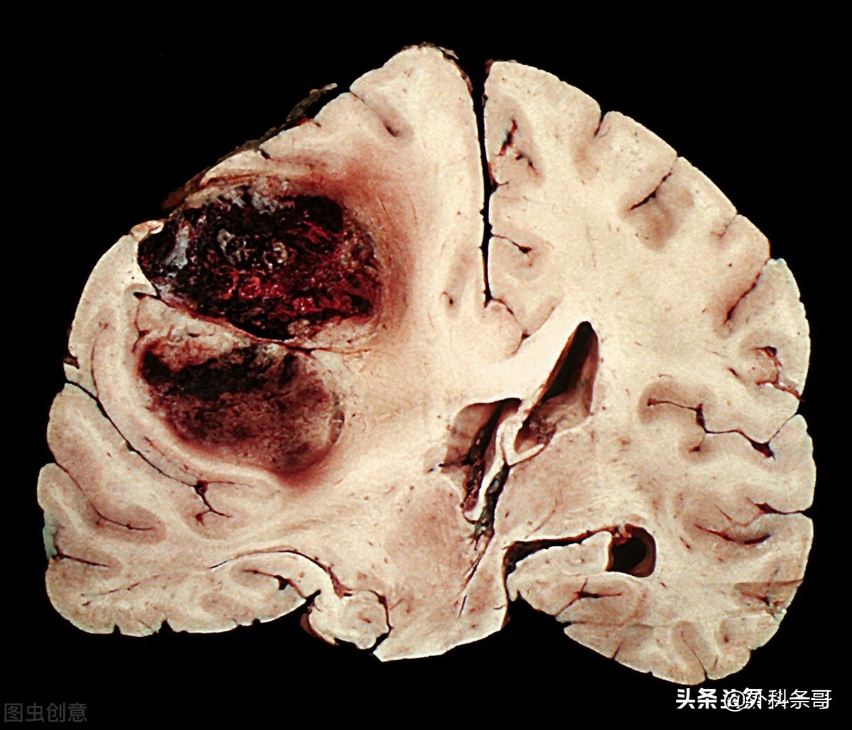 脑出血脑疝开颅手术后遗症,脑出血后遗症偏瘫能手术治疗吗