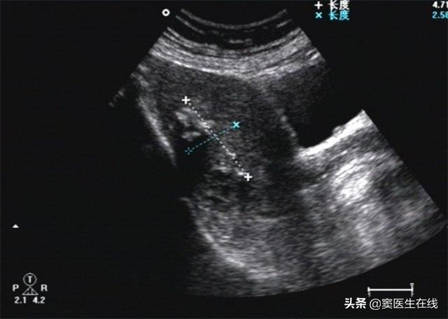 绝经越晚身体衰老得就越慢吗,女性绝经后容易得子宫内膜癌