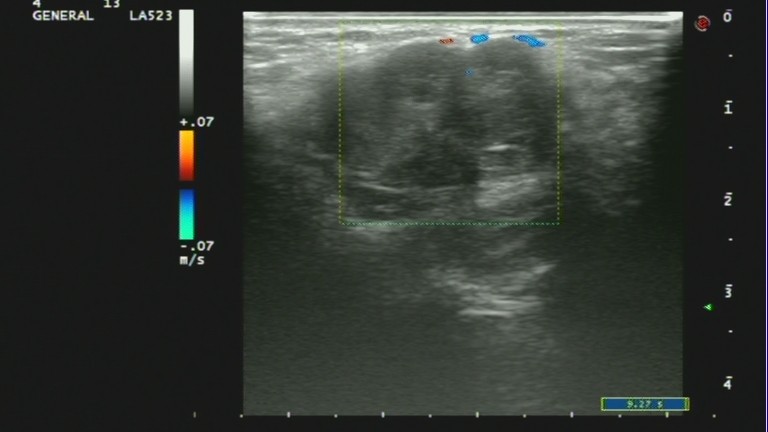 乳腺癌彩超能看出淋巴异常吗,乳腺结节和乳腺癌彩超区别