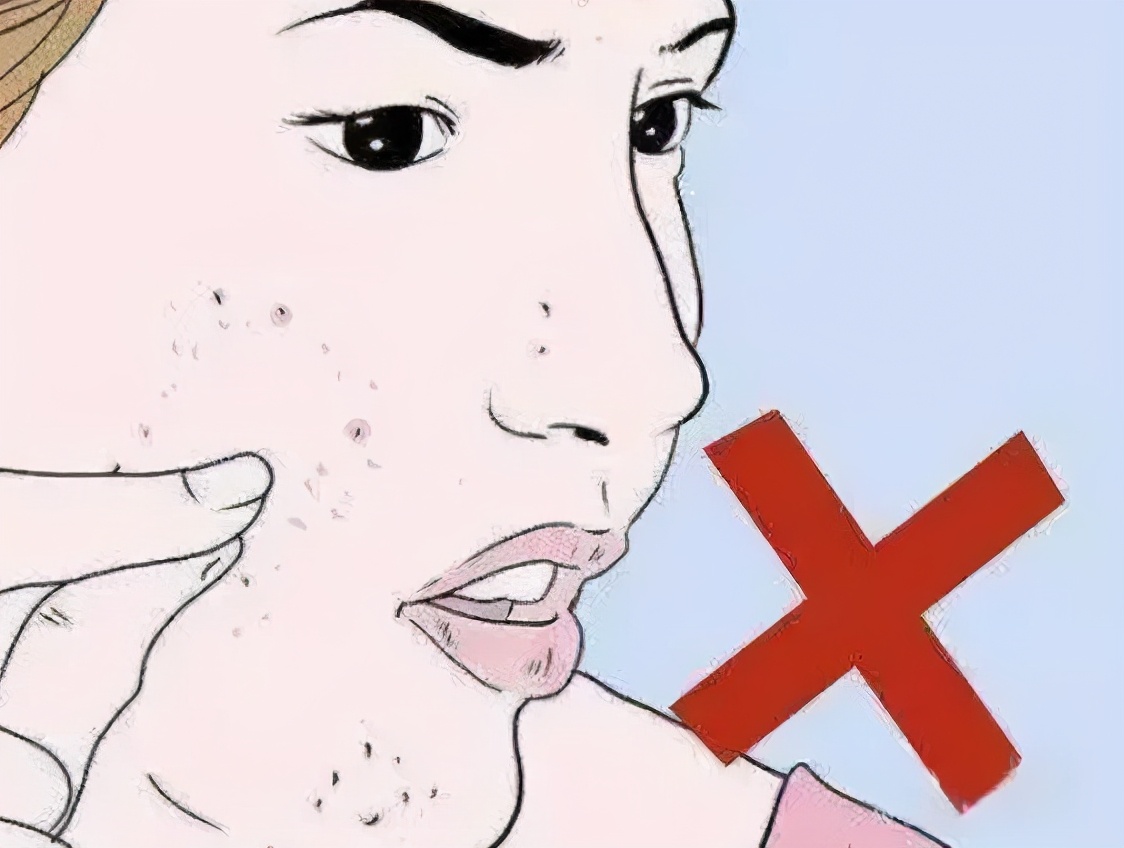 祛痘痘祛痘印,祛痘痘祛痘印的药膏推荐