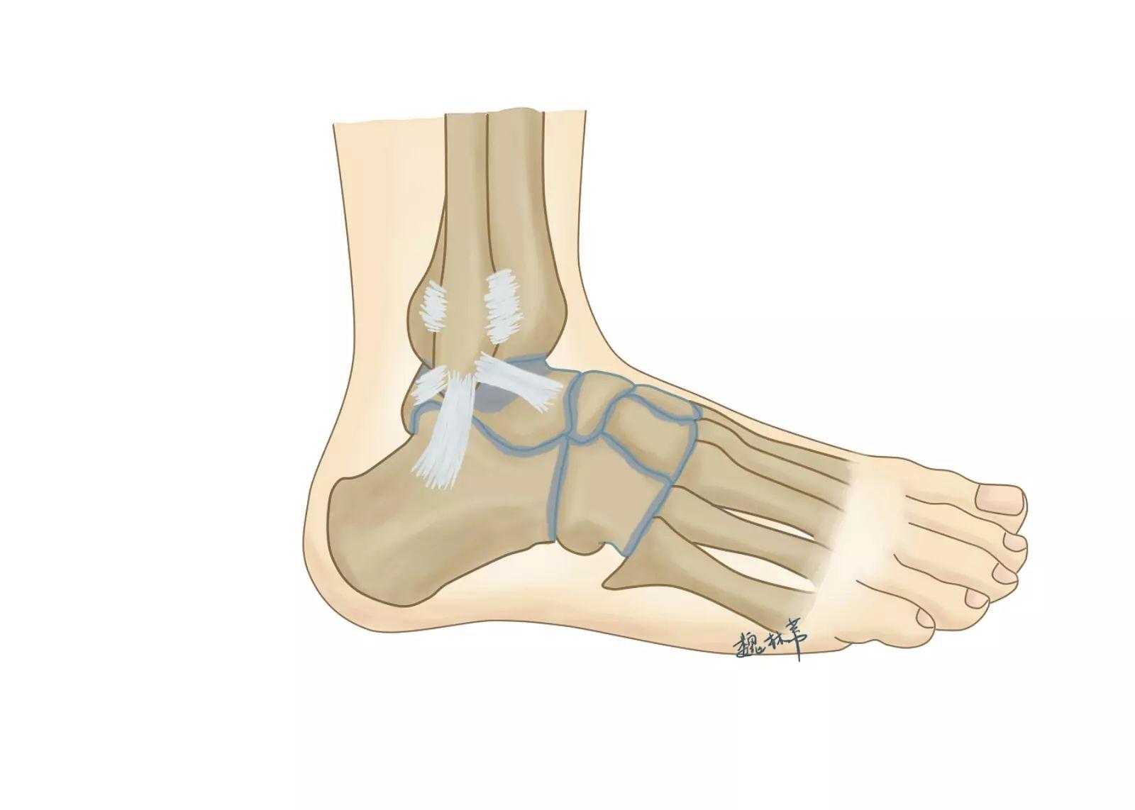 跟腱陈旧性断裂缝合方法有哪几种,陈旧性跟腱断裂能治好吗