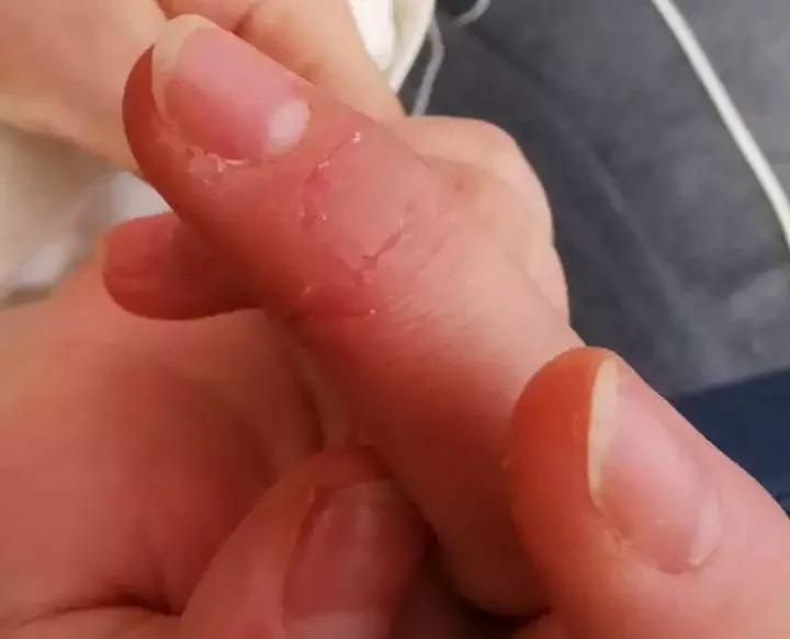 手上脱皮是什么真菌,手上脱皮真菌感染抹什么药膏好