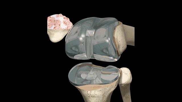 膝关节置换最坏后果,膝关节置换手术吓人
