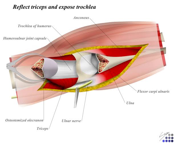 肱骨髁上骨折使用什么钢板,肱骨近端骨折保守治疗会粘连吗