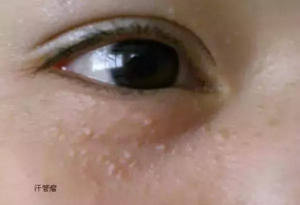 粉刺是什么应该怎么治,粉刺怎么样才算好了