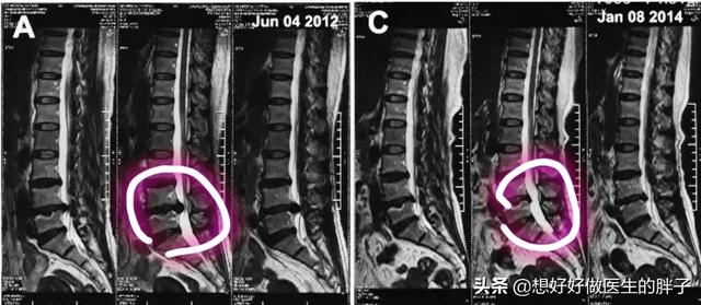 专家教你如何防治腰椎间盘突出症,腰椎间盘突出和腰突有什么关系