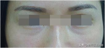 如何区分结构性泪沟,泪沟太明显怎么自己改善