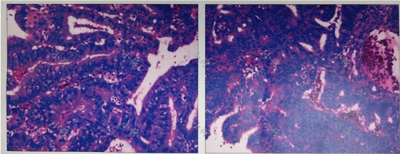 绝经1年后出血伴左腹痛,绝经后一年出血查出子宫内膜癌