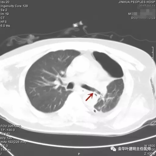 不典型鳞状细胞不明确可怕吗,不典型性鳞癌是什么