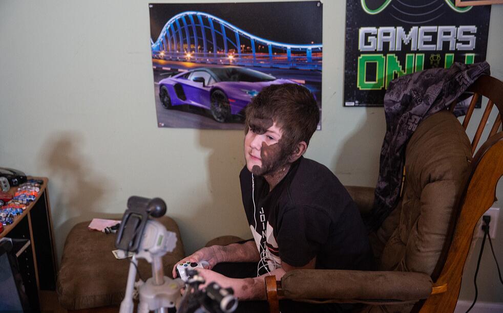 美国男孩患罕见疾病,美国男孩患绝症