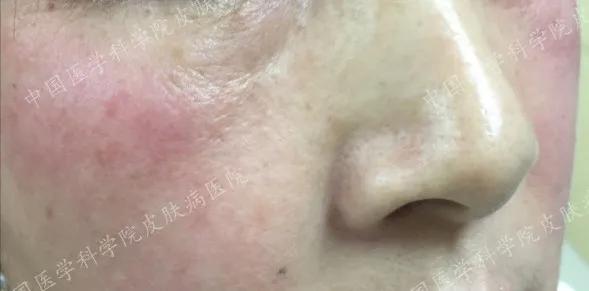 炎炎夏日如何正确护理皮肤,换季皮肤怎么防敏感