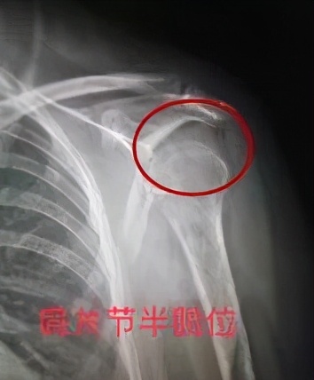 卒中后怎么恢复身体,偏瘫患者肩胛骨后凸