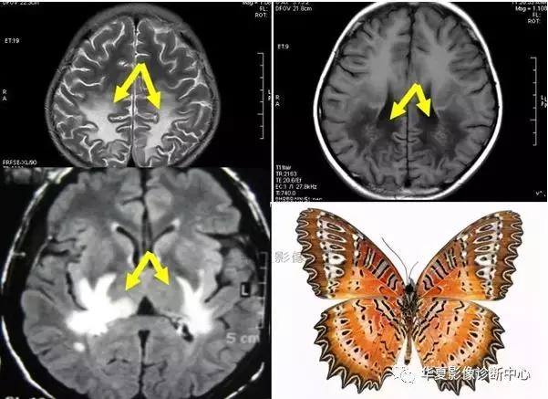 颅脑核磁影像解剖图谱,颅脑mr增强影像图片