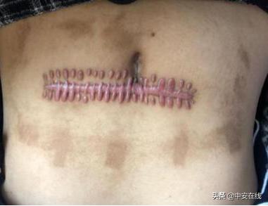 18岁时候嘴唇长黑斑,脸上有黑斑的小女孩做手术