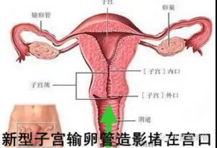 三亚妇幼保健院输卵管造影无痛,石家庄哪个医院有无痛输卵管造影