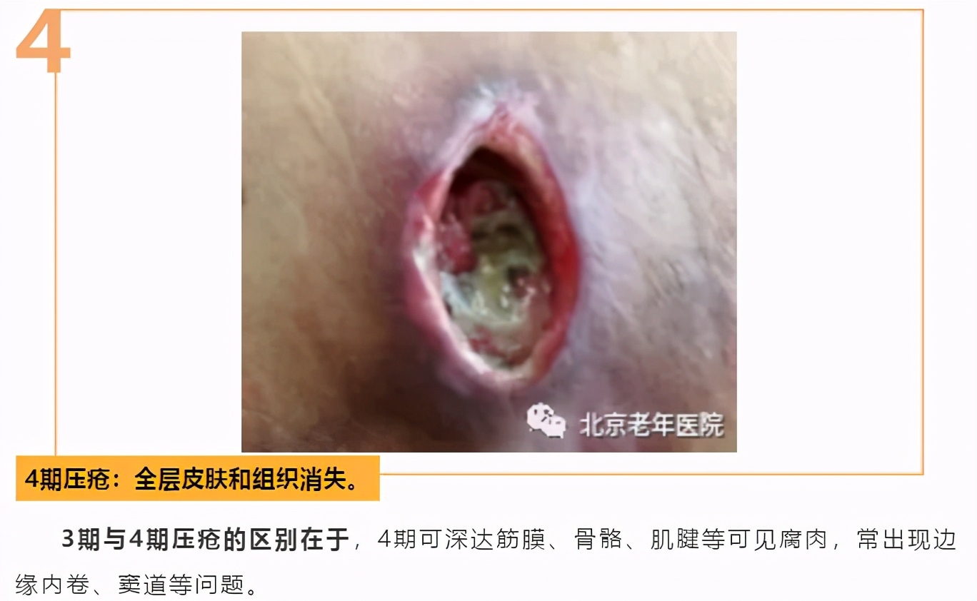 老年人防压疮的饮食照护原则,三度压疮老年人的家庭照护