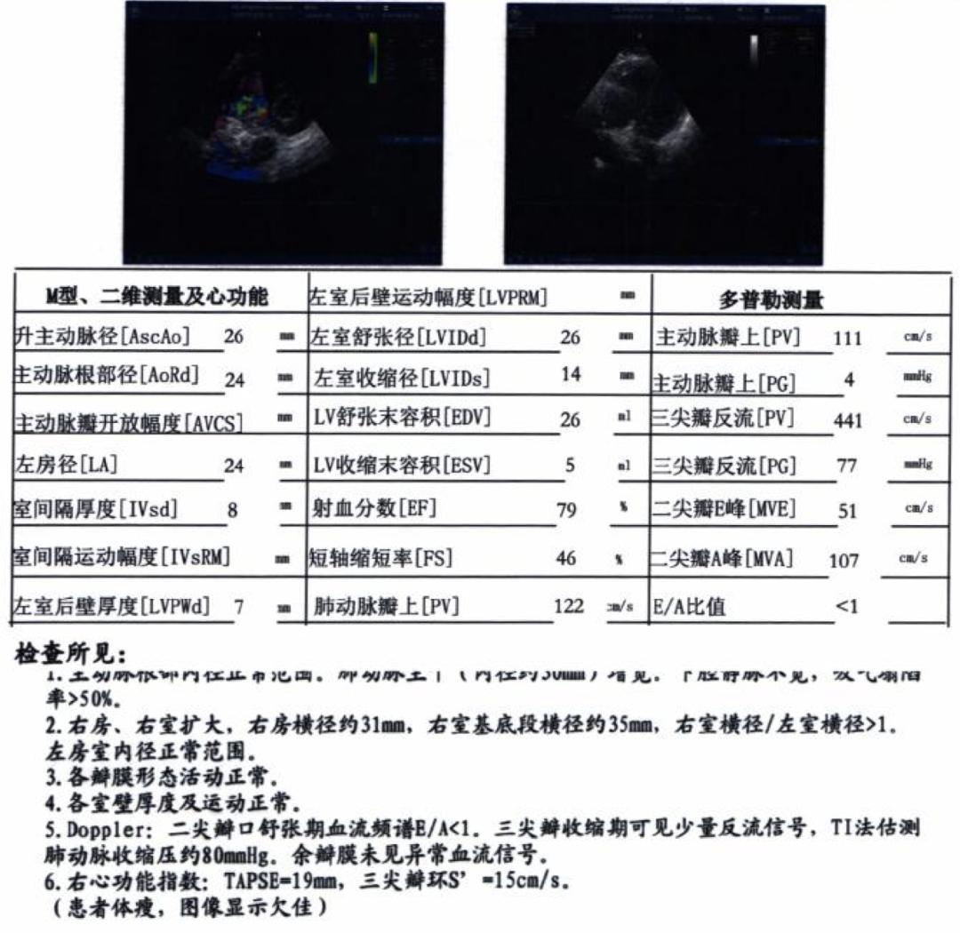肺动脉高压患者咳嗽有血去哪治疗,肺动脉高压患者能进行呼吸康复吗