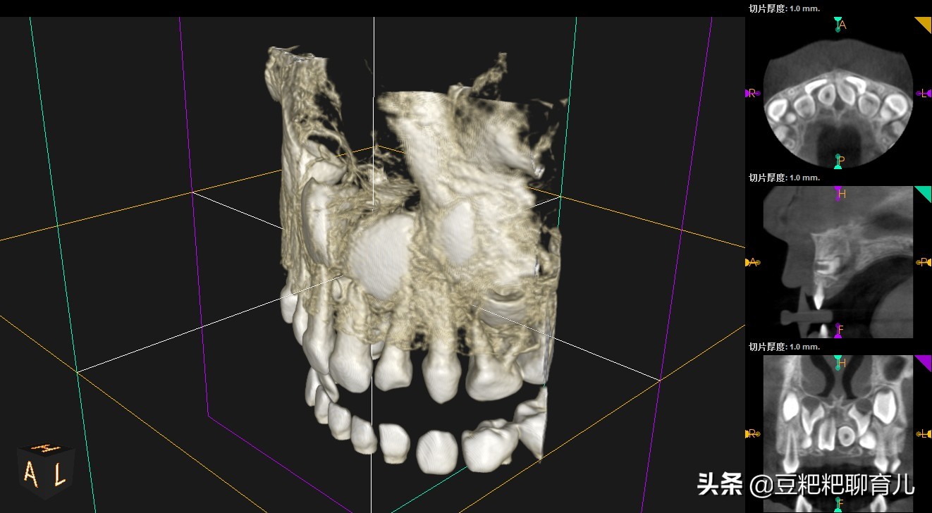 孩子的牙齿疾病之一，越来越多的孩子有“多生牙”，你了解它吗？