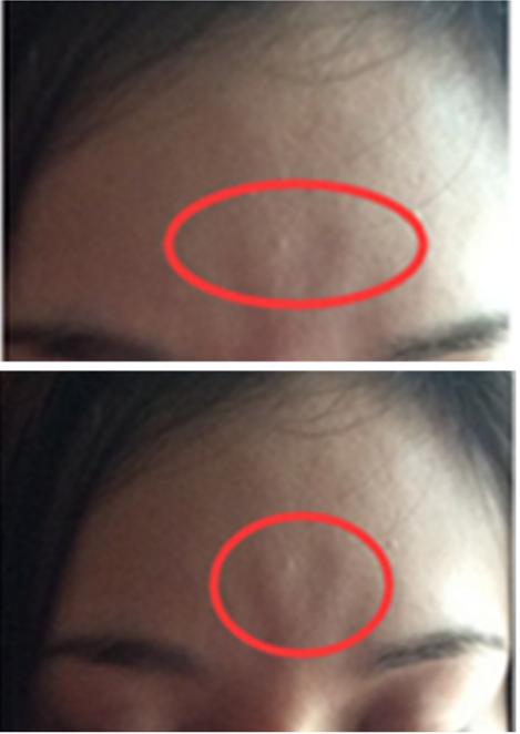 自体脂肪填充的5个坑一定要避开,自体脂肪填充一次能达到效果吗