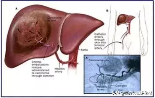 肝血管瘤中医治疗方法,肝血管瘤需要治疗么