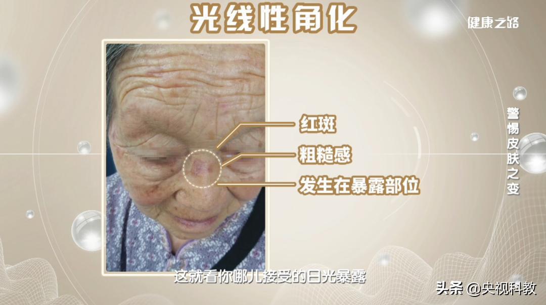 皮肤病毒疣的症状,皮肤疱疹病毒症状