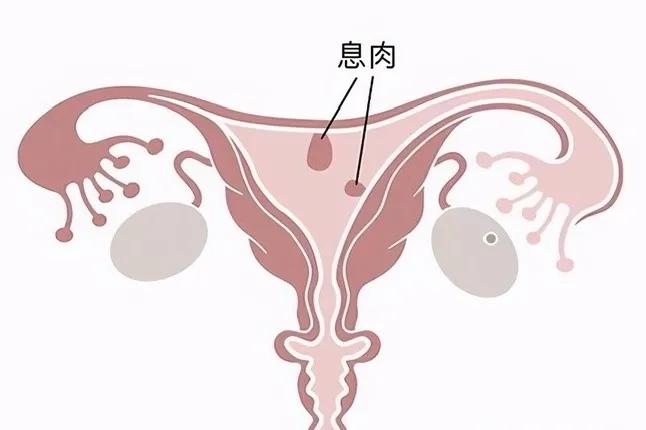 子宫内膜息肉会影响胚胎发育吗,子宫内膜息肉会影响着床后不生长吗