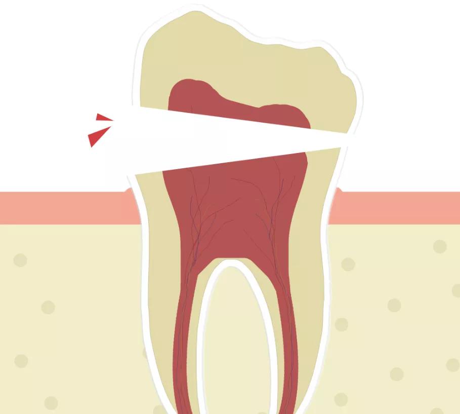 咬硬物导致牙齿松动怎么办,牙齿咬到硬物后破裂要整个拔除吗