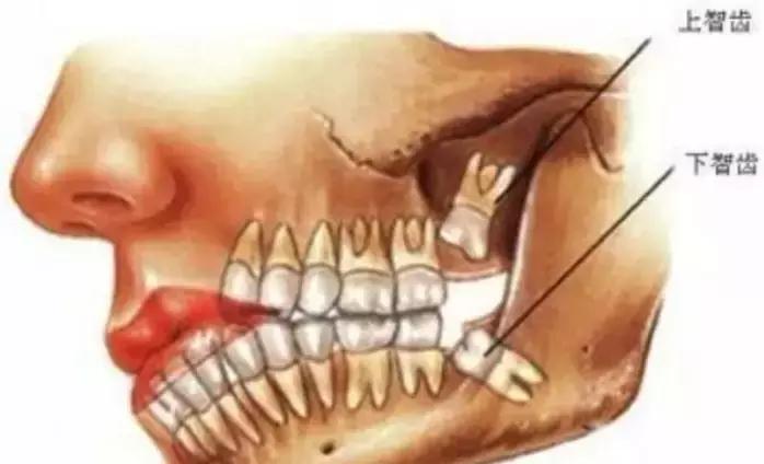丽水小伙拔个牙住院三天、暴瘦10斤、脸肿成“方形”！这两类人赶紧检查一下