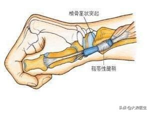 抱孩子抱出妈妈手，腱鞘炎怎么办？手把手教您解决