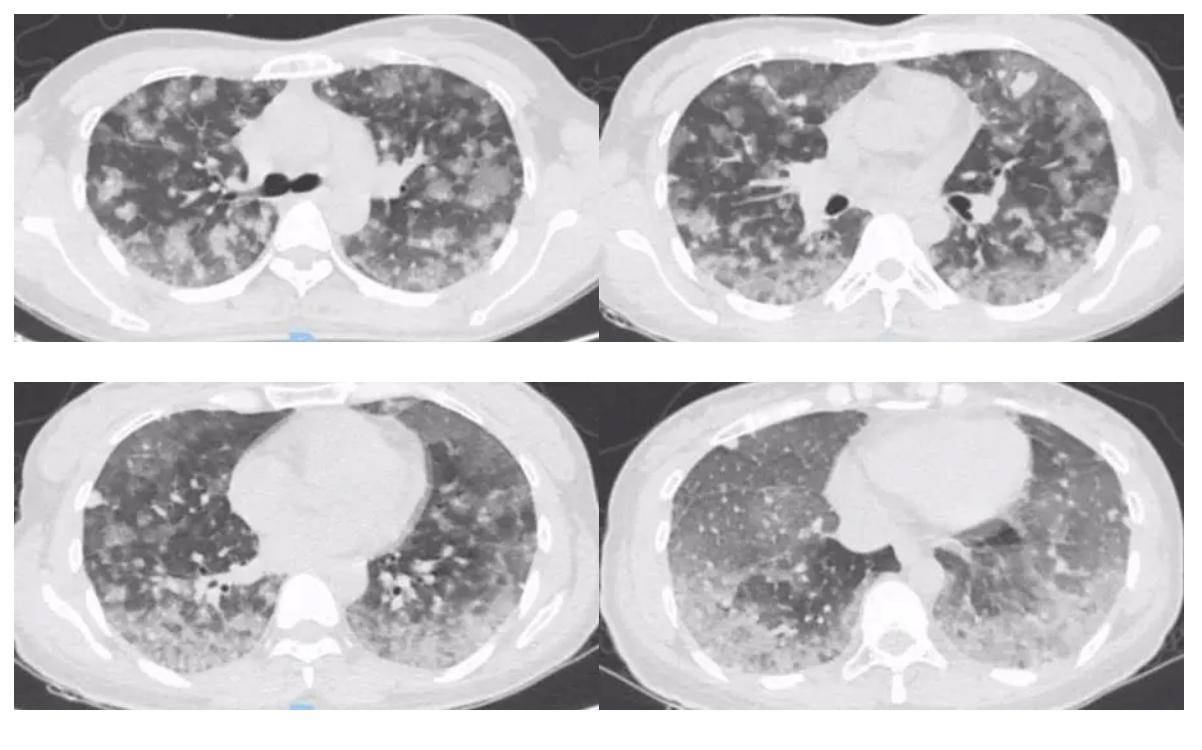 弥漫性肺泡出血是怎么回事,弥漫性肺泡出血症病因分类