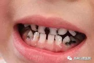 乳牙蛀牙清除真实全过程,小儿乳牙龋齿民间治疗偏方