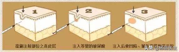 注射玻尿酸脸部浮肿怎么办,什么玻尿酸注射鼻子不会扩散