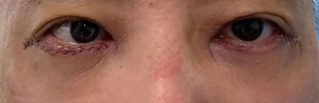 眼袋消除三个方法,教你一个简单消除眼袋的方法