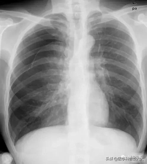气胸在ct怎么诊断肺压缩,气胸单侧肺压缩多少是手术指征