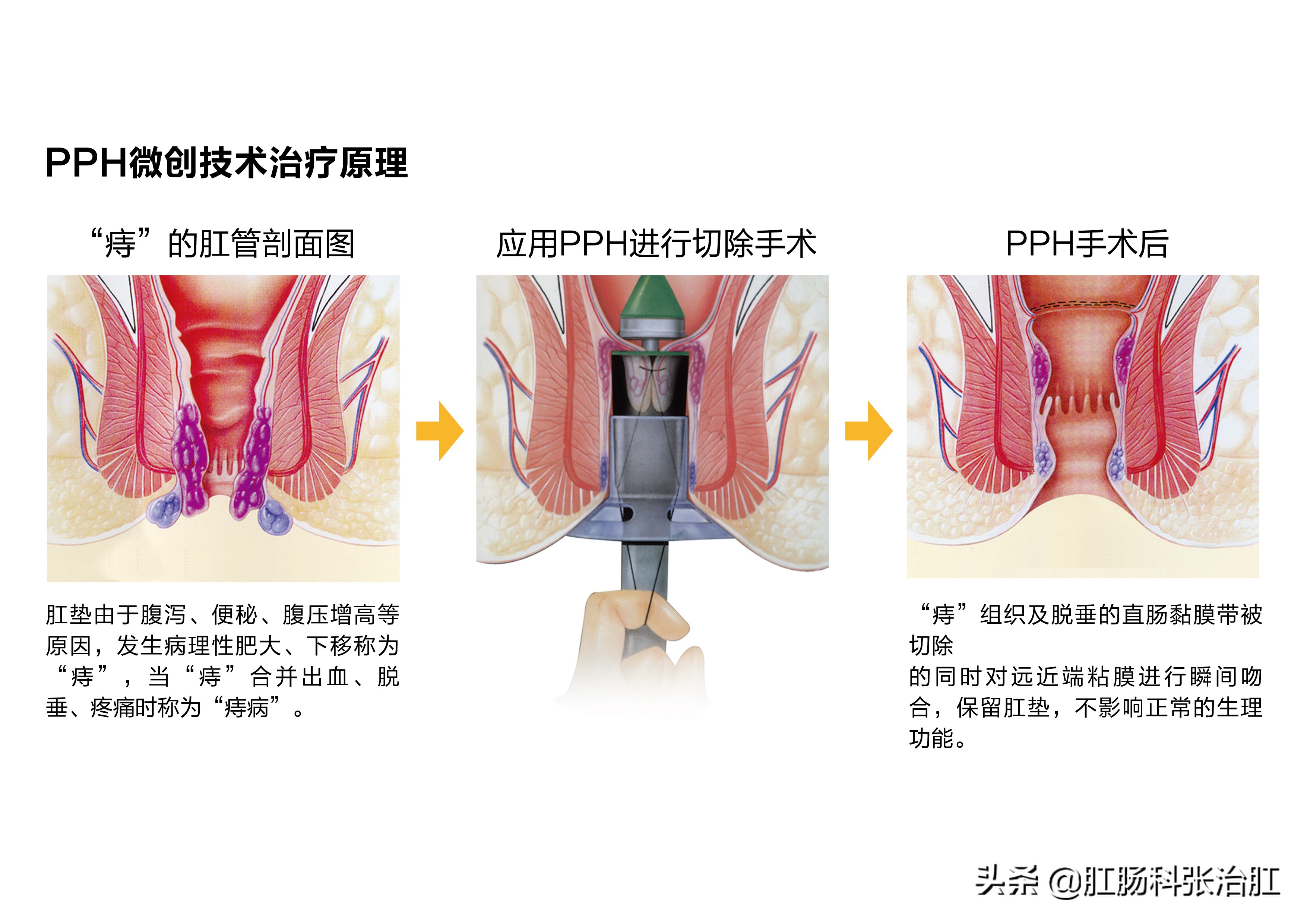 有痔青年经典语录,有痔青年下一句